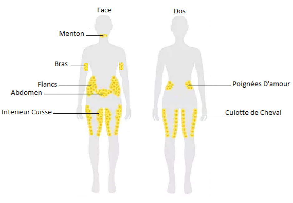 Zones de traitement cryolipolyse