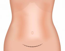 Abdominoplastie