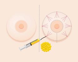 Augmentation mammaire par réinjection de graisse ou lipomodelage