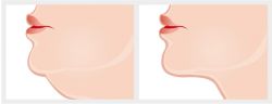 Lifting cervico facial
