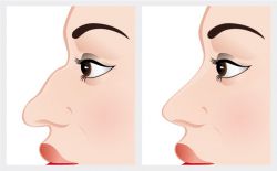 Rhinoplastie chirurgicale